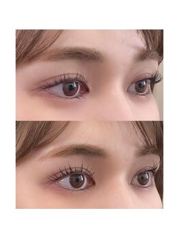 メディカルサロン バリオーニ/匠美容液のビフォーアフター♪