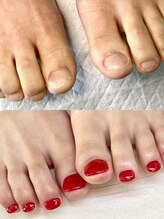 ポメロ(POMELO)/足の爪も深爪矯正出来ます！