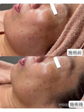 ハイフン(HIFUN) ララピール 毛穴小顔