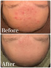 命の洗濯/４ヶ月/お肌の赤みが綺麗に