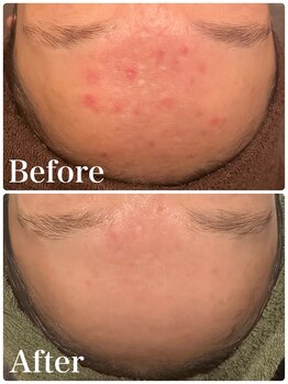 命の洗濯/４ヶ月/お肌の赤みが綺麗に