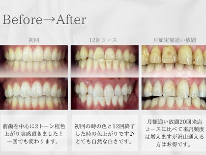 ホワイトニングバー 心斎橋オーパ店の写真