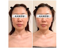 カモン(KAMON)の雰囲気（【美顔矯正】食いしばり/エラ張り改善で小顔・たるみアプローチ）