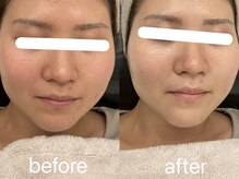 ヴィセラ(Vicella)/毛穴洗浄でピーリング効果も！