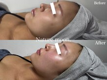 ナチュールムーン(Nature moon.)/ピーリング