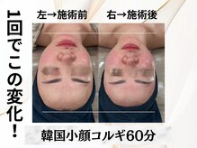 イヨヨ(iyoyo)/【小顔コルギ60分】Before After