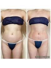 アクアモア/アクアモアの痩身★BeforeAfter