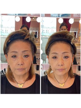 ワイズサロン(Y's salon)/フェイシャル症例3♪