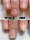 深爪矯正2ヶ月経過　5回継続