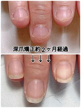 スマイルニコ(smile nico)/深爪矯正2ヶ月経過　5回継続