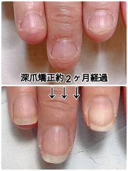 スマイルニコ(smile nico)/深爪矯正2ヶ月経過　5回継続