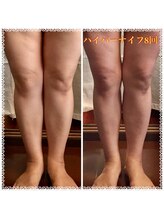 サロン ド ソワ(salon de soi)/ハイパーナイフ足