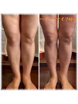 サロン ド ソワ(salon de soi)/ハイパーナイフ足