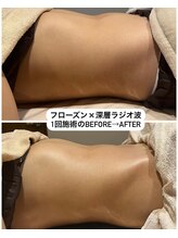 カーム(CALM.)/フローズン・深層ラジオ波1回