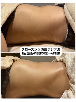 カーム(CALM.)/フローズン・深層ラジオ波1回