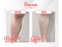 ティアナ 高知店(Tiana)/脱毛　Before&After