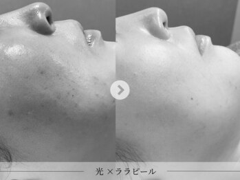 スパレーカ(Spa laka)/赤み・ニキ◯跡ケア