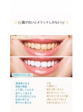 セルフホワイトニングサロン　エクシアホワイトニング宇治小倉店/ビフォーアフター