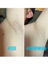 エルア バイ ヘア サロン エスペース(elua by Hair salon espace)/脱毛効果