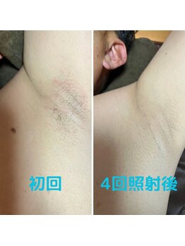 エルア バイ ヘア サロン エスペース(elua by Hair salon espace)/脱毛効果