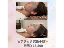 ウナ デ リンゴル 恵比寿店(UNA de Ringol)/究極小顔リフト！初回¥13,500-