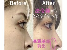 ラプリ 横浜店(Raplit)/隆鼻＋輪郭矯正40分