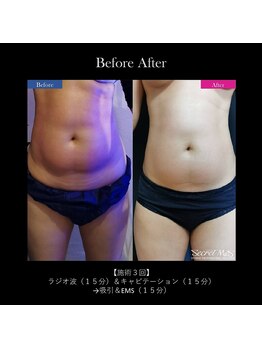 レクリエイター(Re:QREATOR)/セルフエステ(before after)