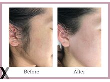 クロス(Xcross)/フェイスワックス【毛穴/渋谷】