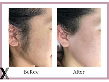 クロス(Xcross)/フェイスワックス【毛穴/渋谷】