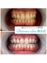 ホワイトニングサロン 三重県桑名店/ホワイトニング/ホワイトニング