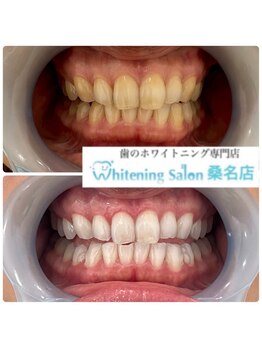 ホワイトニングサロン 三重県桑名店/ホワイトニング/ホワイトニング