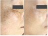 【40代以上の方予約率NO1】稲毛でシミ改善をするならエスティフルにおまかせ