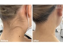 アップパイン(UPPINE)/うなじビフォーアフター