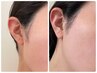 人気no２衰退したお肌の機能を取り戻す【エクソソーム肌質改善コース】