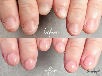 ツメハピ(tumehapi)/深爪ビフォーアフター