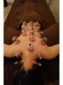 ラースパ アザブ(La SPA azabu)&nbsp;カッピングによってお身体の滞りがある箇所が明確になります
