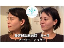ミノリノモリ(Minorinomori)の雰囲気(美容鍼で本気のケア!たるみ、ほうれい線でお悩みの方へ!)
