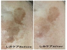 しみケアコース2回ピーリングコース2回施術後。しみ体験￥6600～