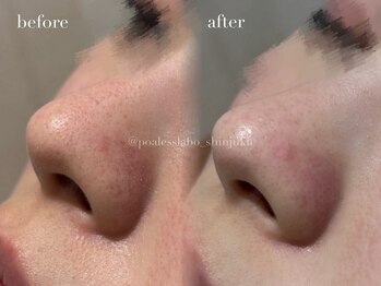 ポアレスラボ 新宿マルイ本館店/お客様ビフォーアフター