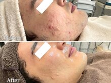 ニキビケア研究所 横浜店/メンズのニキビ悩みにも◎