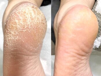 ウェルネスマルカ(wellness MARCA)の写真/【久屋大通駅スグ★】【エンザイム角質ビットケア75分ご新規様¥13200】かかとの角質などのお悩み解決♪
