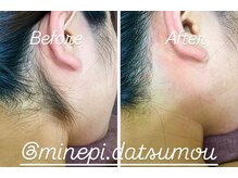 ミンエピ(MinEpi)/うなじ脱毛ビフォーアフター♪