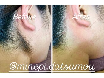 ミンエピ(MinEpi)/うなじ脱毛ビフォーアフター♪