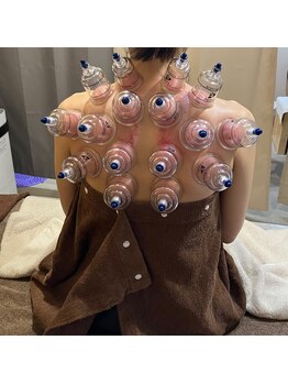 ソルーナ(So-Luna)/カッピング(吸玉)