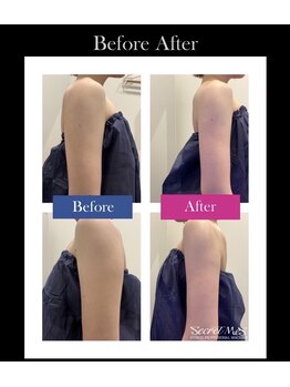 オザキ 西宮北口店(OZAKI)/~痩身施術Before&After~