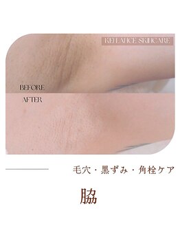 ミークチュール(me couture)/ビフォーアフター 【ワキ1回】