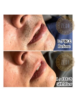 サロンゼロ 池上店(Salon ZERO)/ヒゲ脱毛で髭剃りからの解放♪
