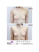 バイオビューティー 神戸本店(Bio Beauty)/プランプバスト　6回コース症例