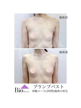 バイオビューティー 神戸本店(Bio Beauty)/プランプバスト　6回コース症例