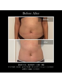 レクリエイター(Re:QREATOR)/セルフエステ(before after)